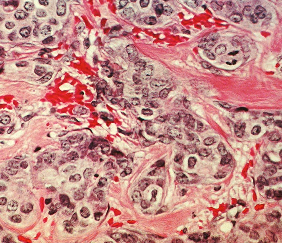 breast-cancer-cells-566x487.jpg