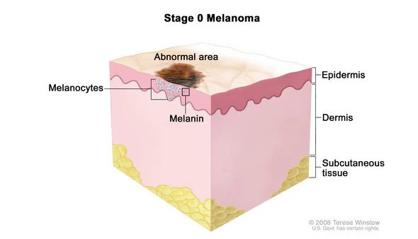 melanoma-stage-0-diagram590x338.jpg