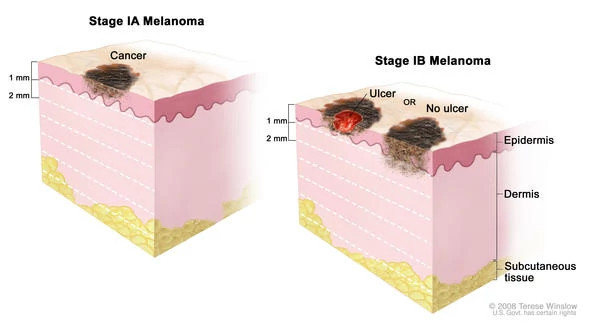 melanoma-stage-i-diagram590x330.jpg
