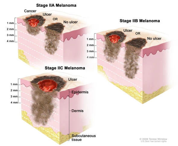 melanoma-stage-ii-diagram590x483.jpg